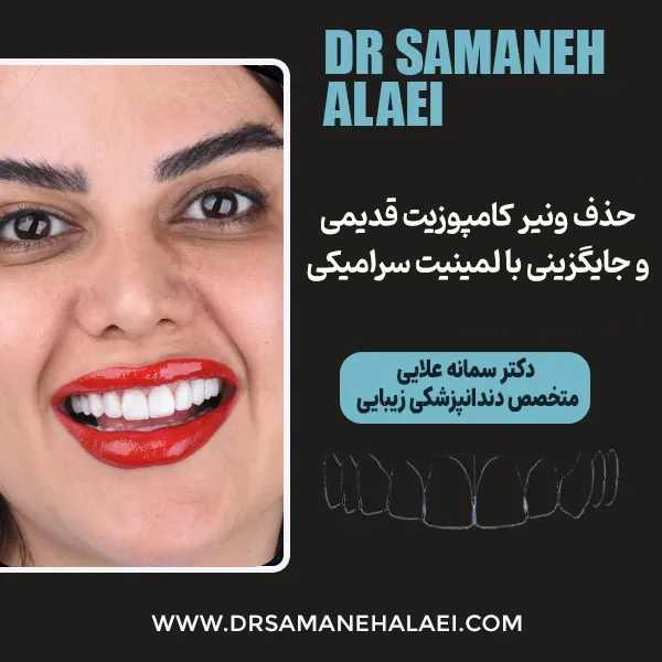حذف ونیر کامپوزیت های قدیمی و جایگزین با لمینیت سرامیکی برای مراجعه کننده عزیز از مرداویج