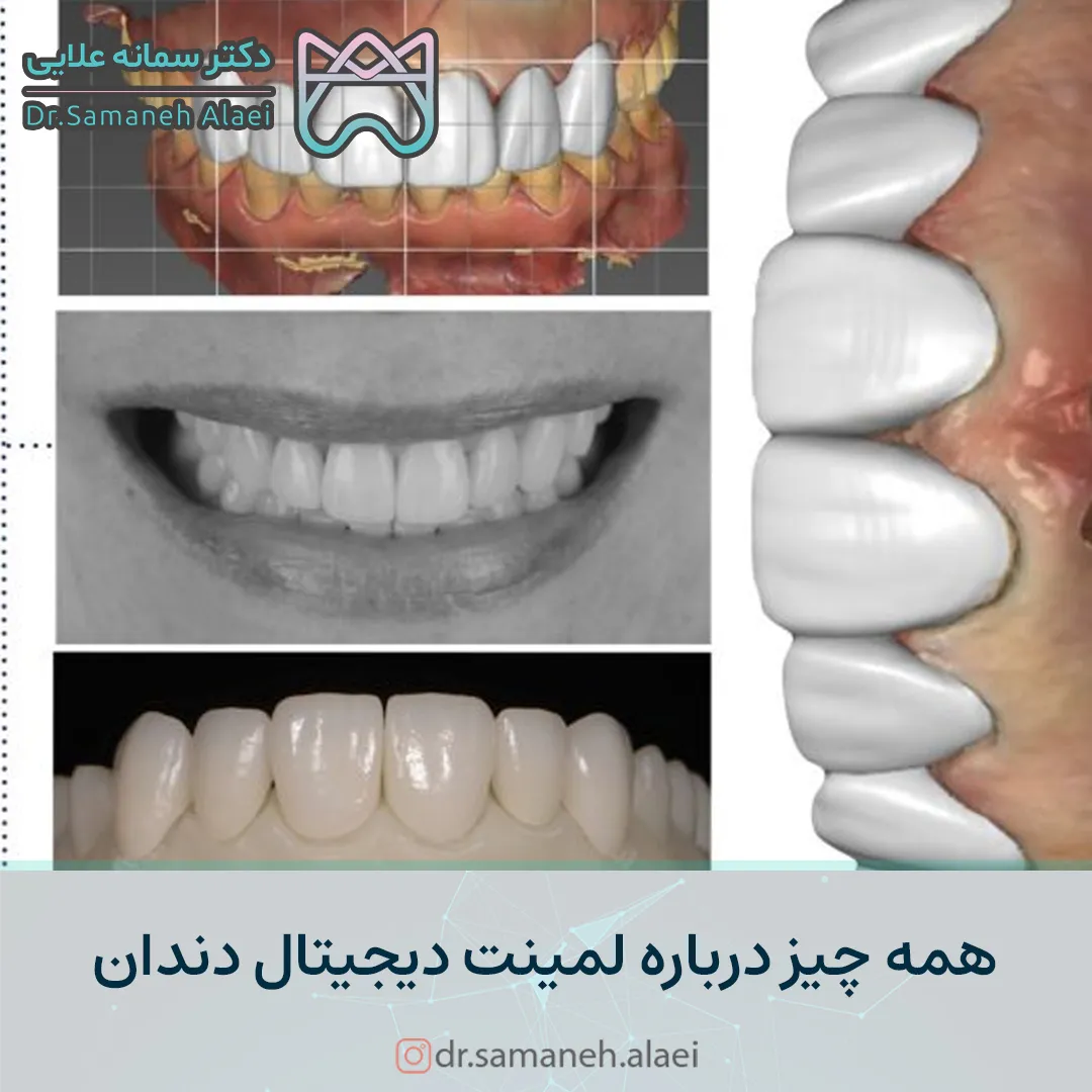 لمینت دندان به روش دیجیتال