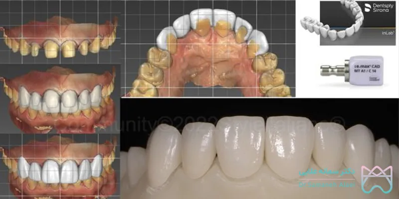 لمینت دیجیتال دندان
