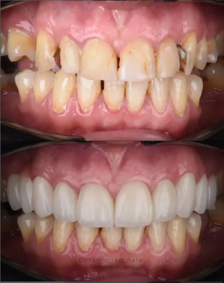 کامپوزیت IPS چیست؟