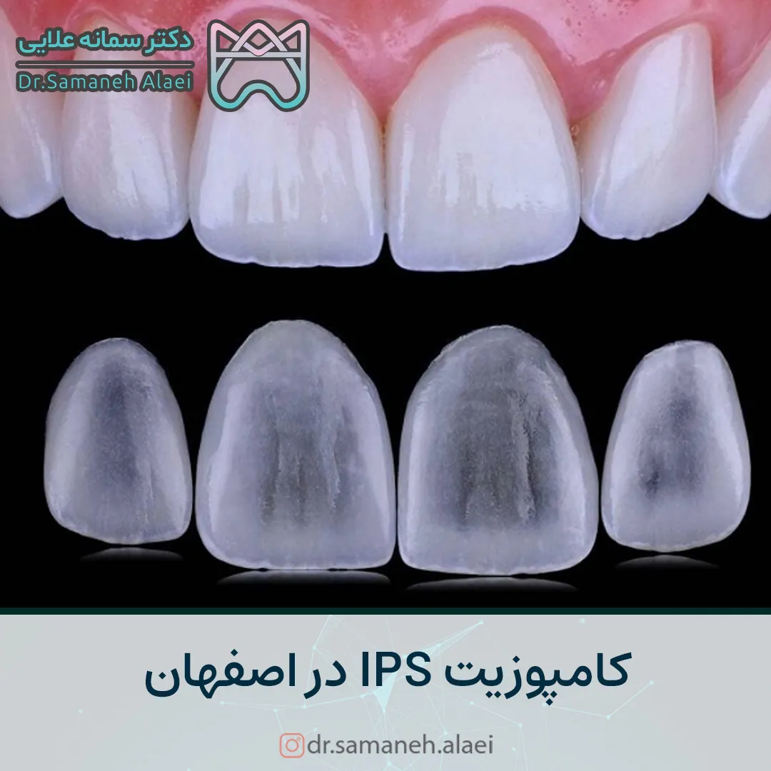 کامپوزیت IPS