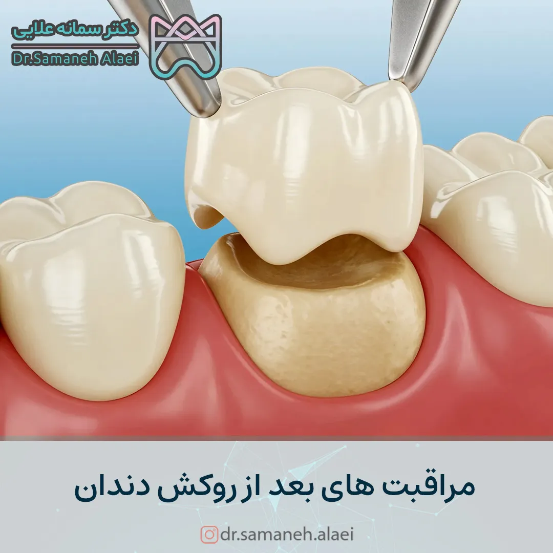 مراقبت های بعد از روکش دندان