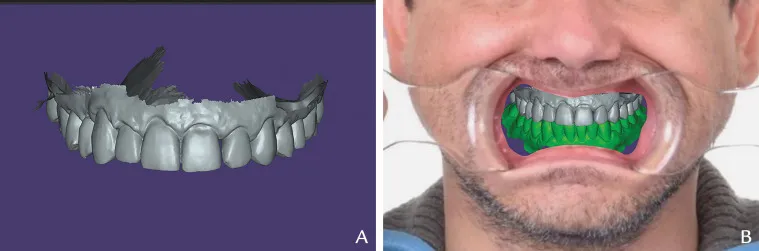 لمینت دیجیتال دندان