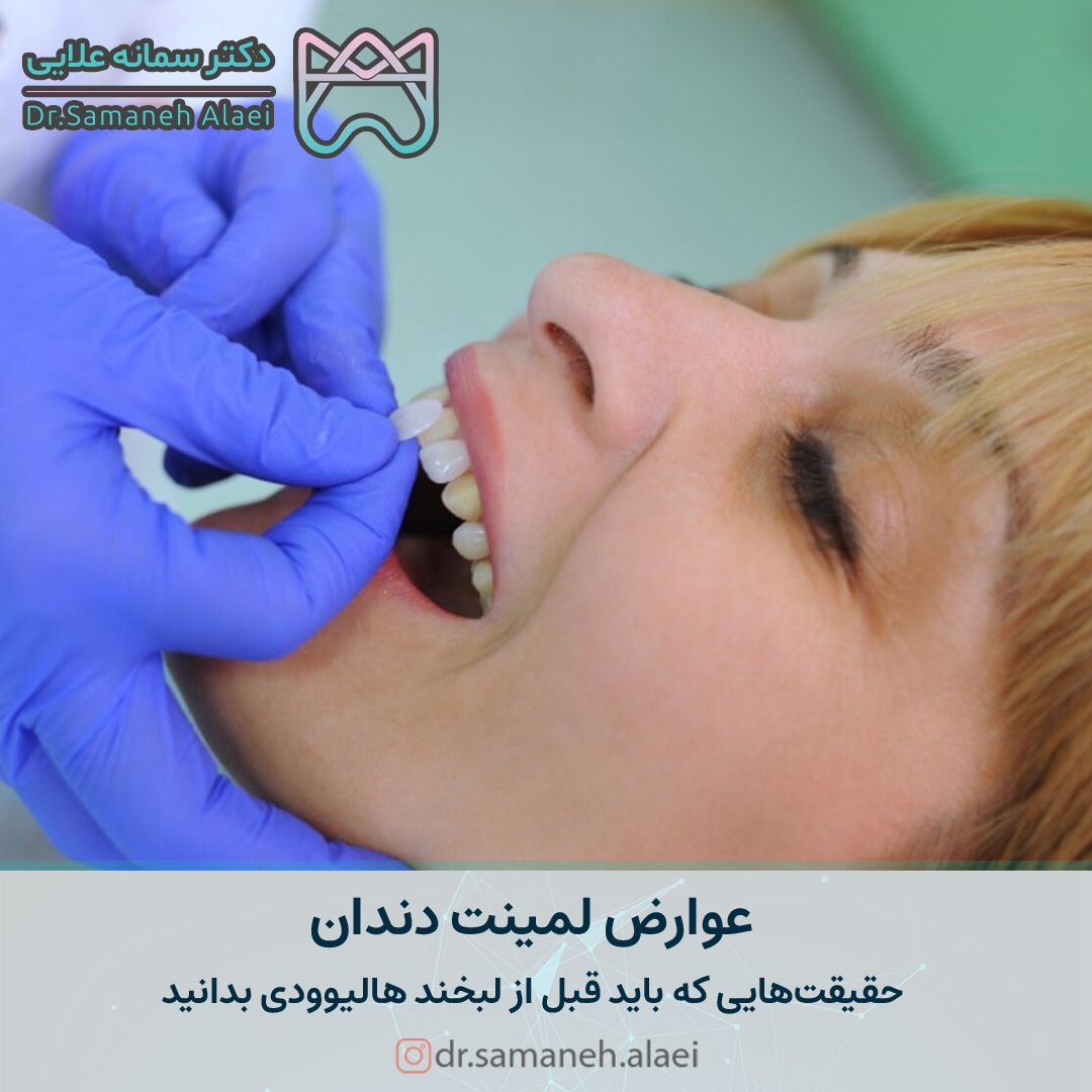 عوارض لمینت دندان