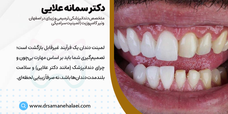 عوارض لمینت دندان