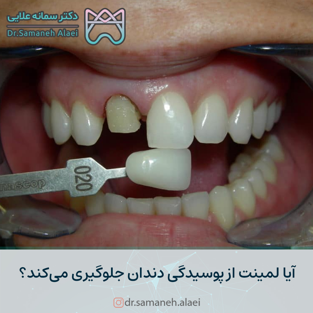 آیا لمینت از پوسیدگی دندان جلوگیری میکند