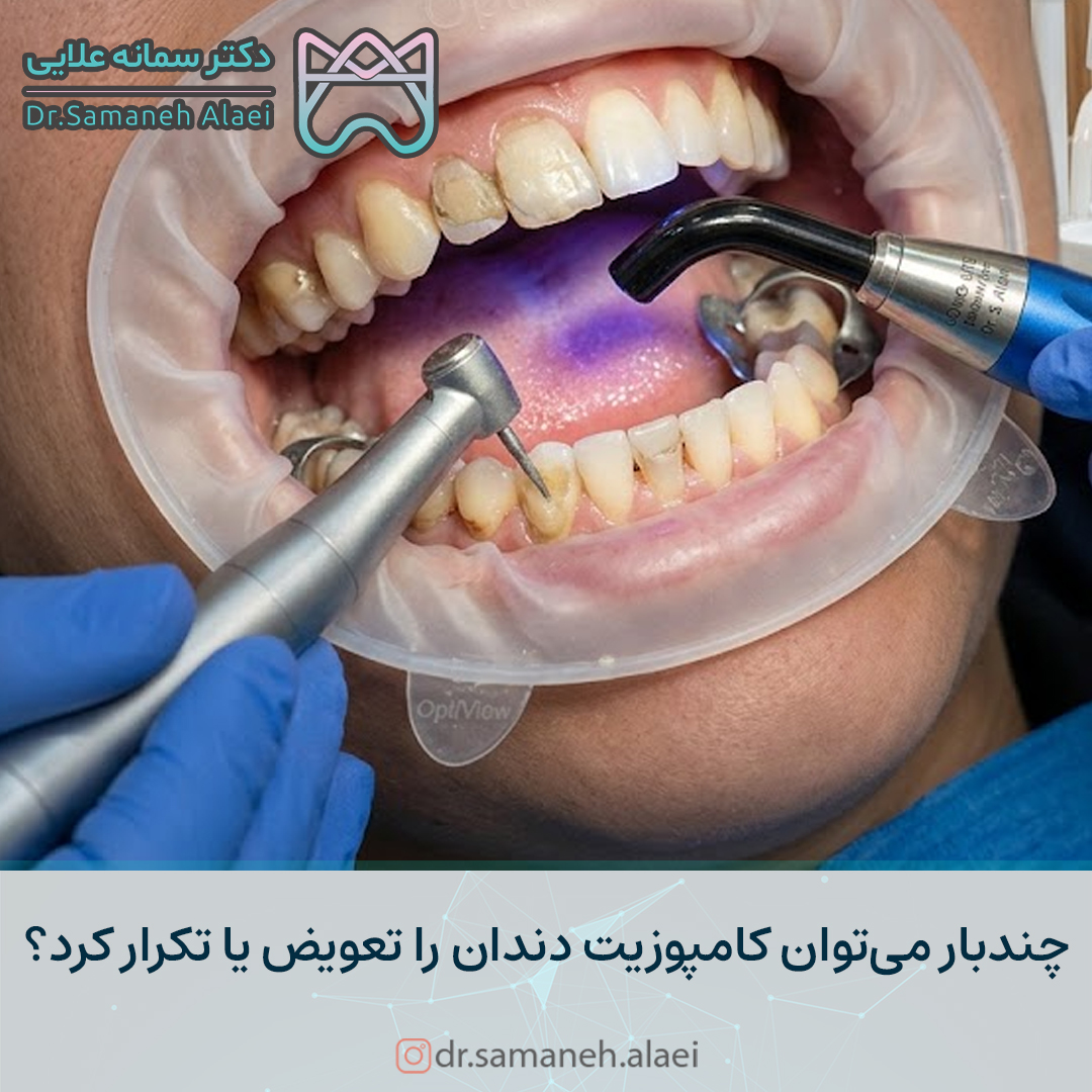 چندبار میتوان کامپوزیت دندان را تعویض یا تکرار کرد؟