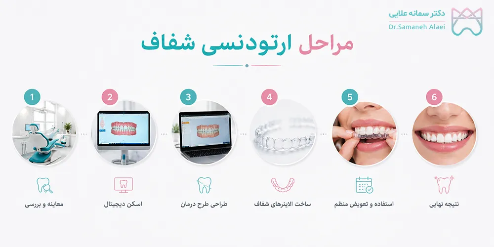 مراحل انجام ارتودنسی شفاف