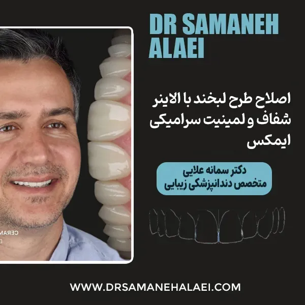 Transparent-orthodontic-treatment-example-in-Isfahan