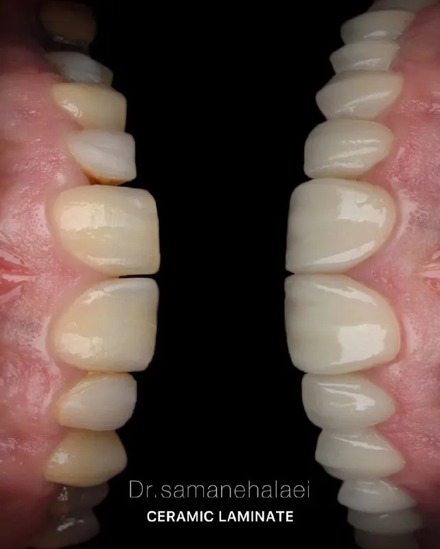 اصلاح طرح لبخند با الاینر شفاف و لمینیت سرامیکی ایمکس در مطب دکتر سمانه علایی