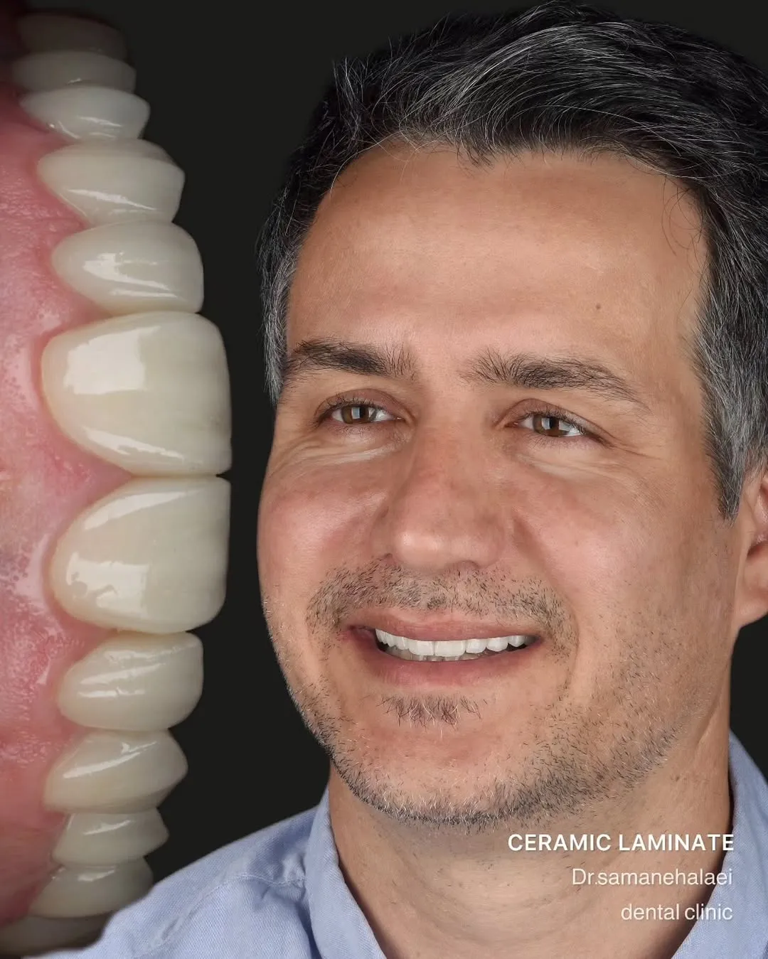 اصلاح طرح لبخند با الاینر شفاف و لمینیت سرامیکی ایمکس در مطب دکتر سمانه علایی