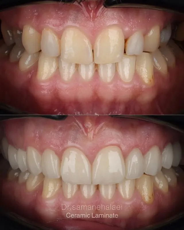 اصلاح طرح لبخند با الاینر شفاف و لمینیت سرامیکی ایمکس در مطب دکتر سمانه علایی