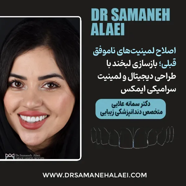 اصلاح لمینیت‌های ناموفق با طراحی دیجیتال لبخند و لمینیت سرامیکی ایمکس