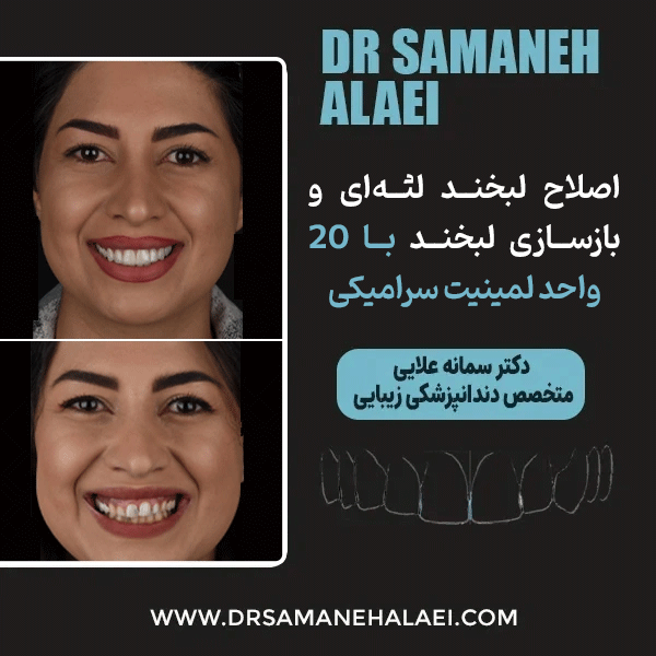 اصلاح لبخند لثه‌ای و بازسازی لبخند با ۲۰ واحد لمینیت سرامیکی مر اجعه کننده از خانه اصفهان