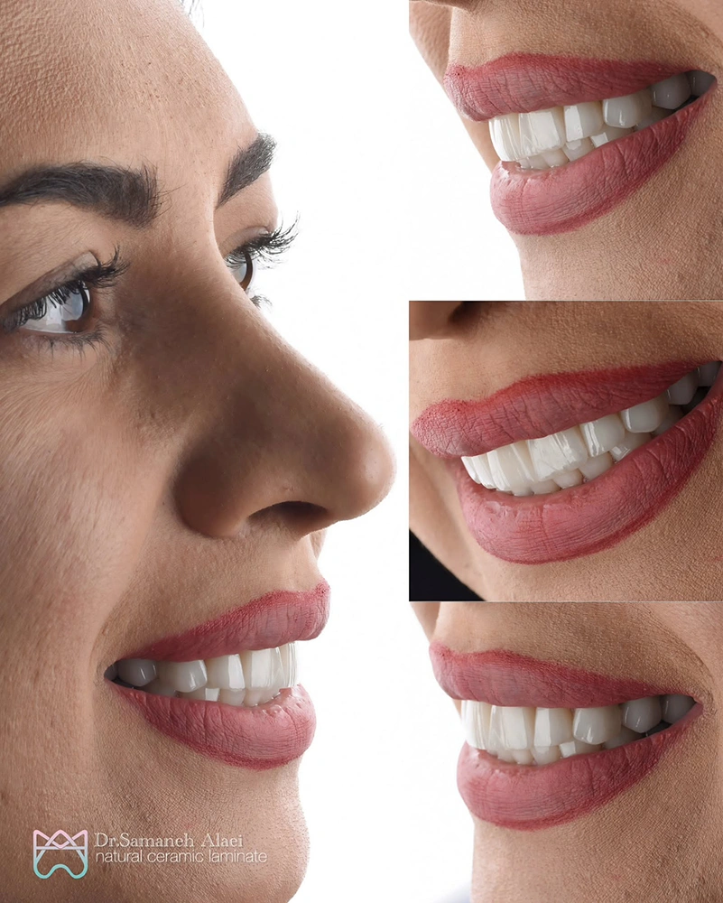 اصلاح لبخند لثه‌ای و بازسازی لبخند با ۲۰ واحد لمینیت سرامیکی مر اجعه کننده از خانه اصفهان