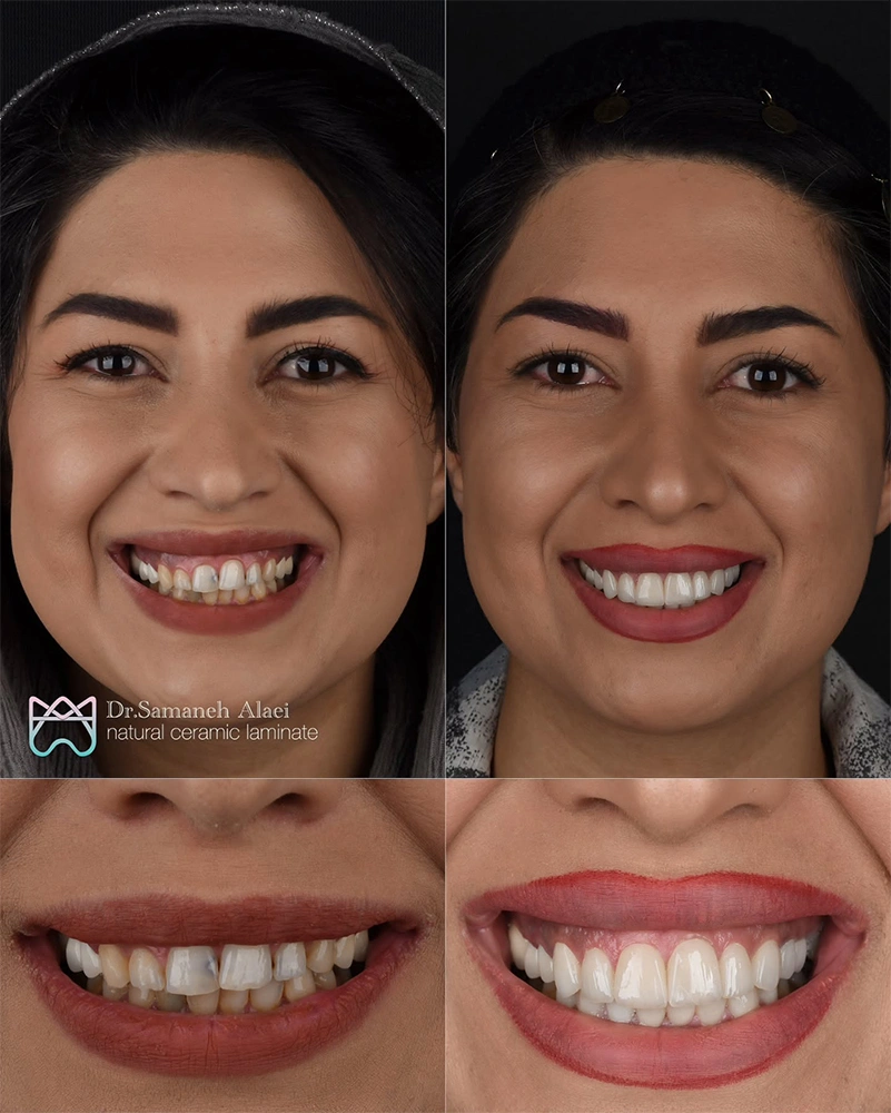 اصلاح لبخند لثه‌ای و بازسازی لبخند با ۲۰ واحد لمینیت سرامیکی مر اجعه کننده از خانه اصفهان
