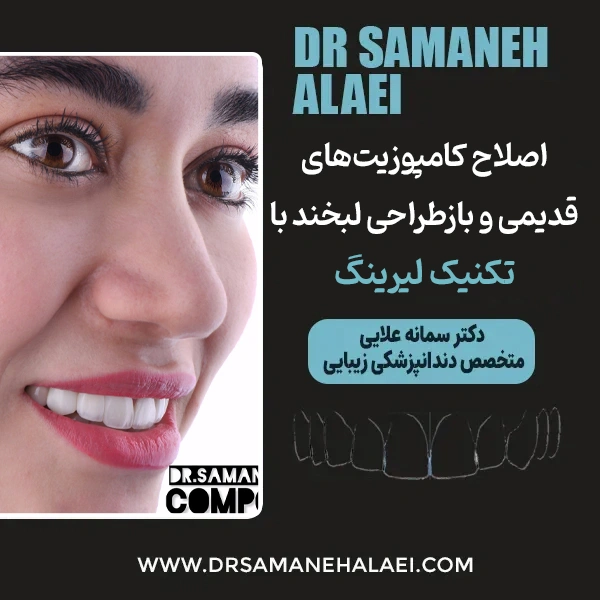 اصلاح کامپوزیت‌های قدیمی و بازطراحی لبخند با تکنیک لیرینگ