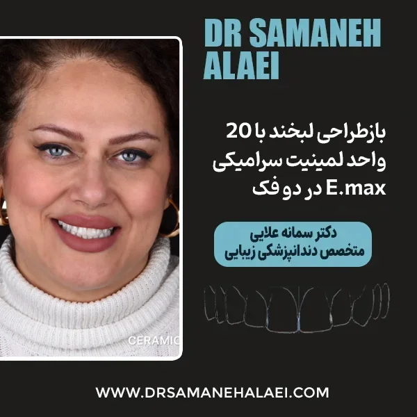 بازطراحی لبخند با ۲۰ واحد لمینیت سرامیکی E.max در دو فک در اصفهان