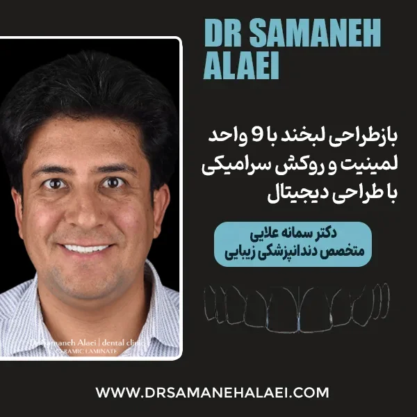 بازطراحی لبخند با ۹ واحد لمینیت و روکش سرامیکی | دکتر علایی
