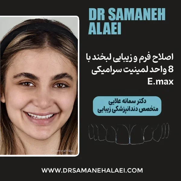 اصلاح فرم و زیبایی لبخند با ۸ واحد لمینیت سرامیکی E.max