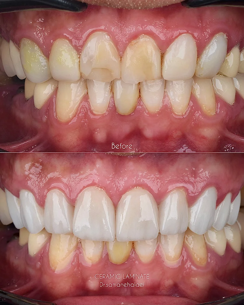بازطراحی لبخند با ۹ واحد لمینیت و روکش سرامیکی با طراحی دیجیتال
