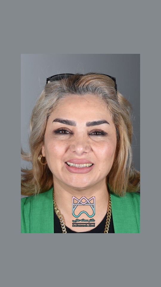 لمینیت سرامیکی دندان در اصفهان دکتر سمانه علایی