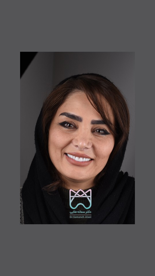 لمینیت سرامیکی دندان در اصفهان دکتر سمانه علایی