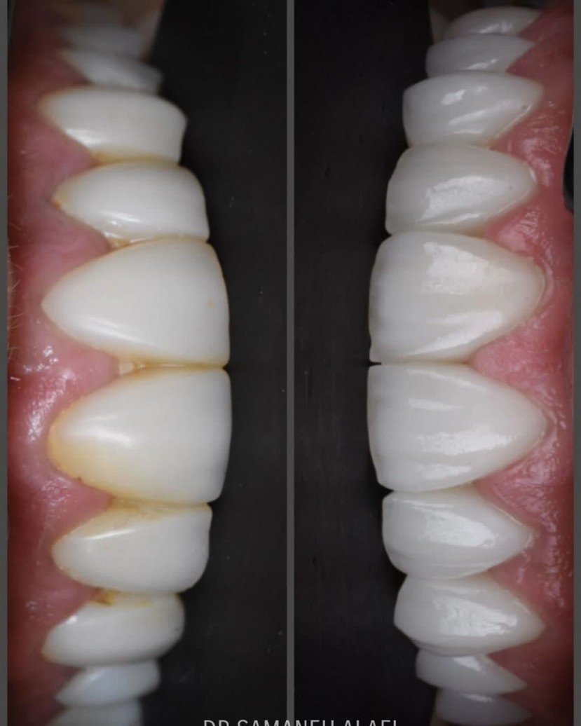 لمینیت سرامیکی در اصفهان