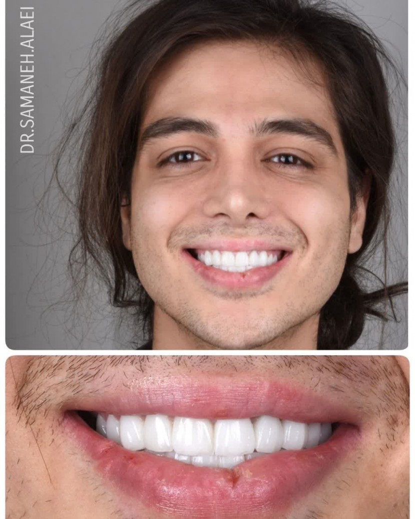 لمینیت سرامیکی در اصفهان