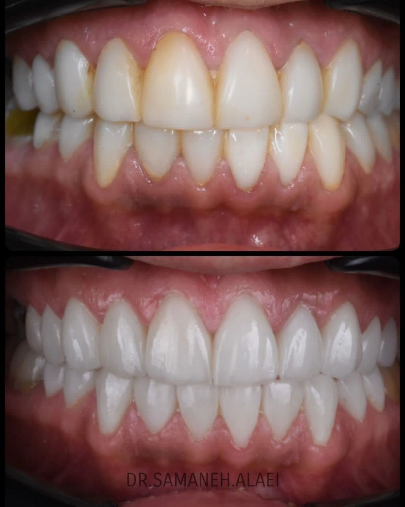 لمینیت سرامیکی در اصفهان