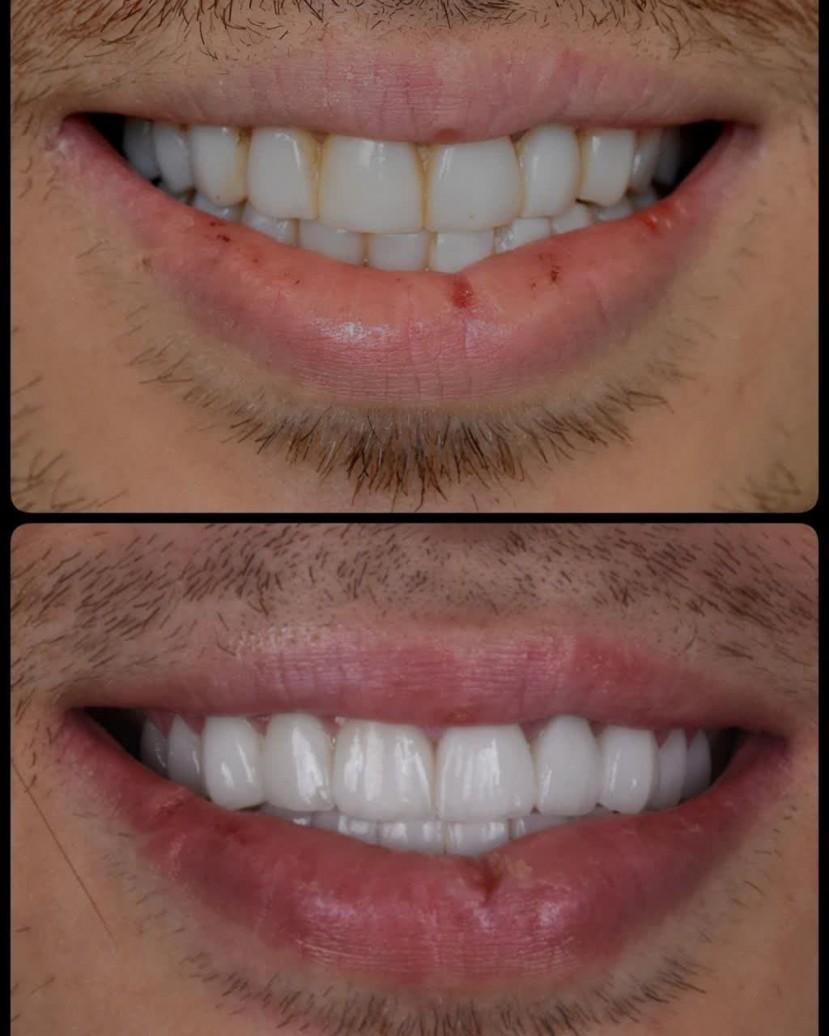 لمینیت سرامیکی در اصفهان