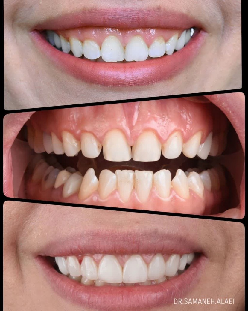 لمینیت سرامیکی در اصفهان