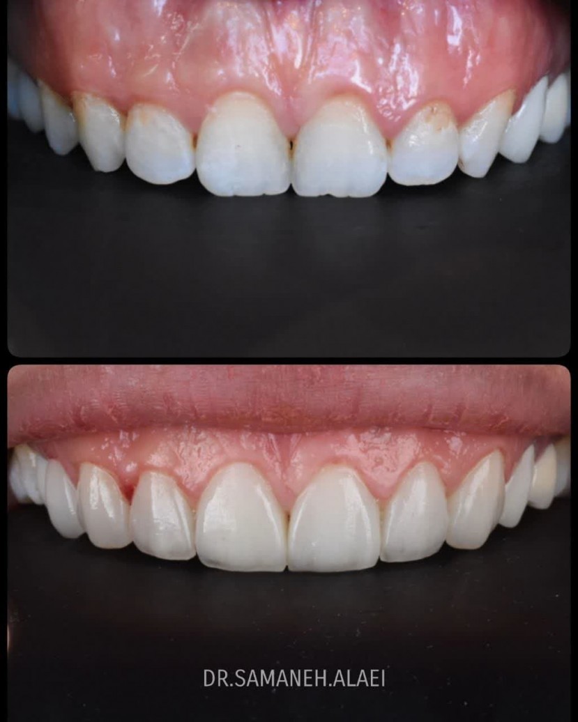 لمینیت سرامیکی در اصفهان