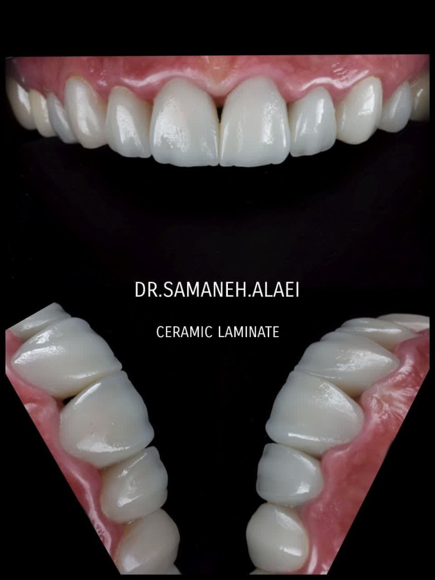 روکشها و لمینتهای سرامیکی ساخته شده با دقت بالا به رنگ bl4 در اصفهان