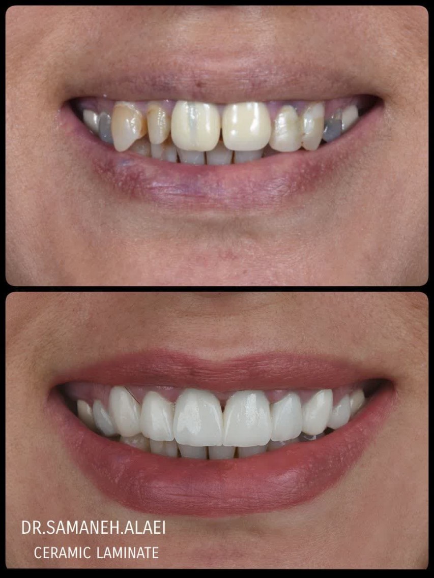 روکشها و لمینتهای سرامیکی ساخته شده با دقت بالا به رنگ bl4 در اصفهان