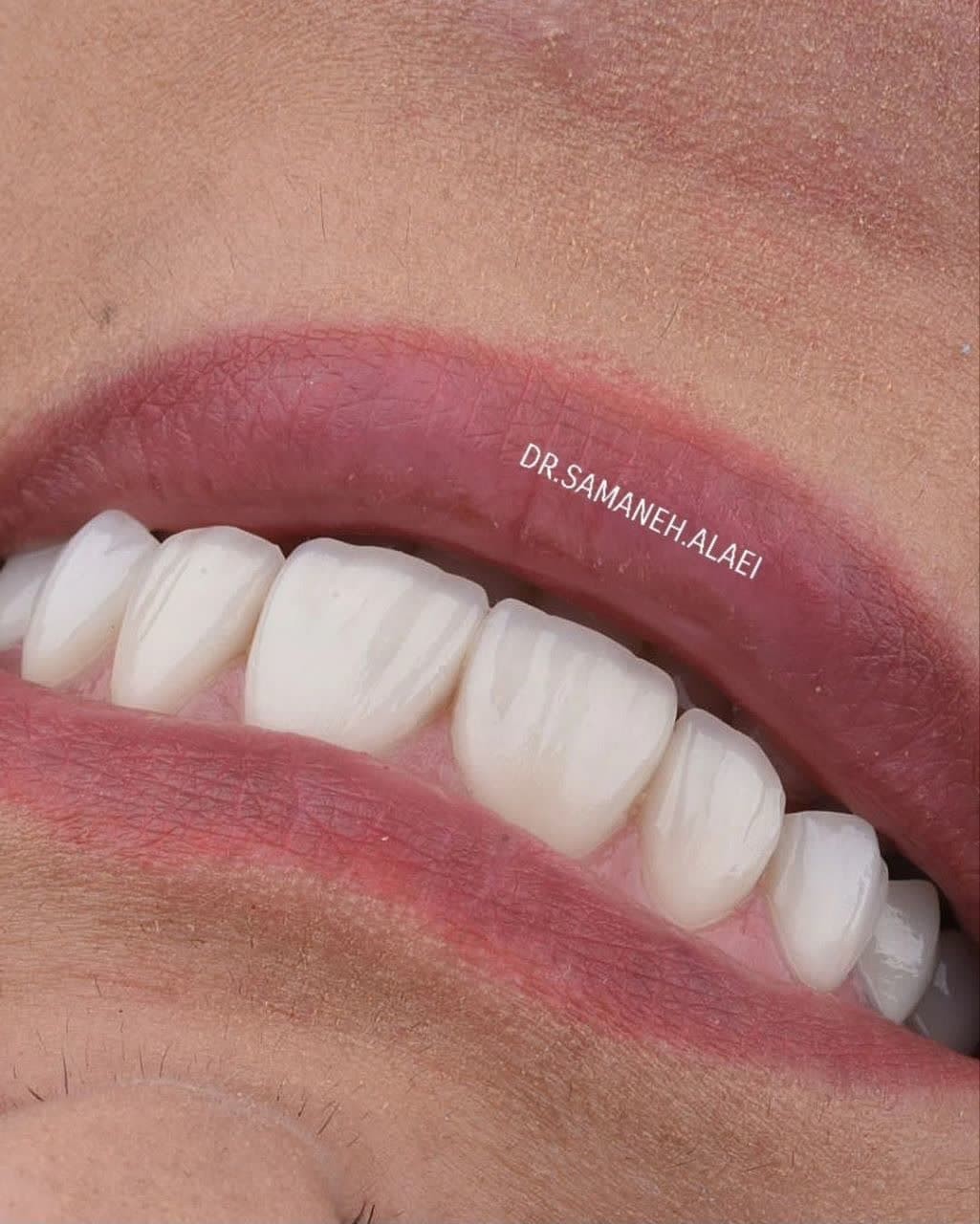 نمونه درمان لمینیت سرامیکی توسط دکتر سمانه علایی متخصص دندانپزشکی زیبایی در اصفهان
