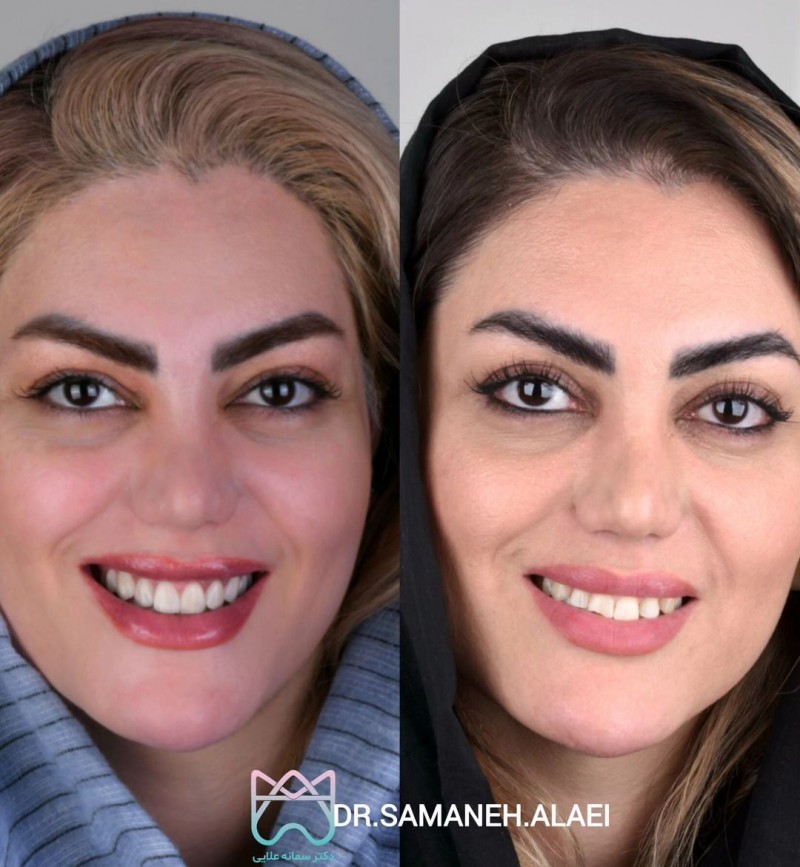 درمان لمینیت سرامیکی و فاصله بین دندانی در اصفهان