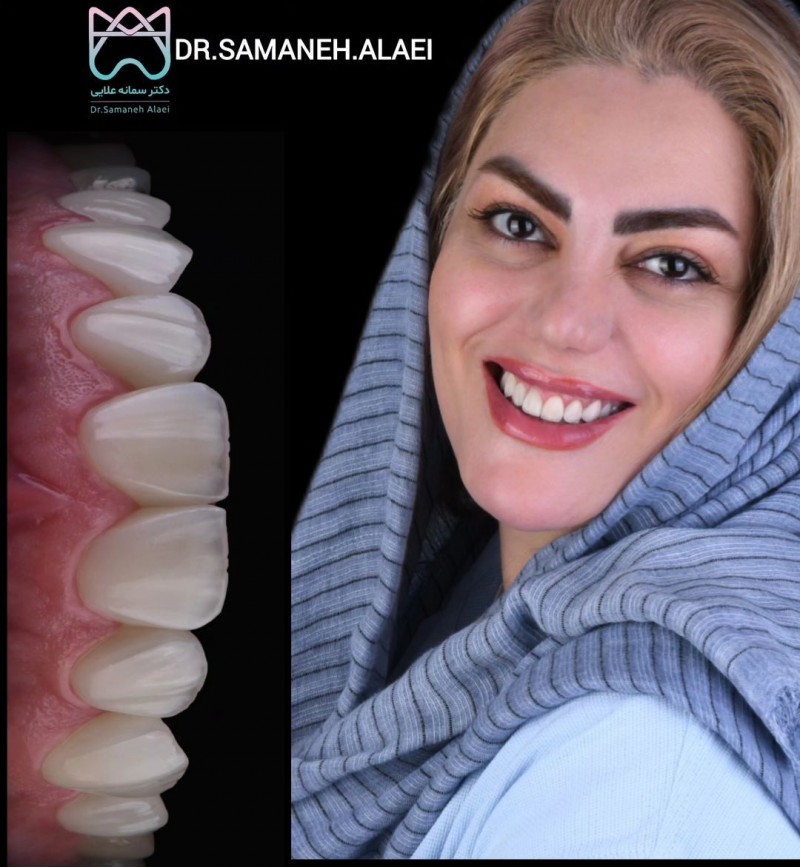درمان لمینیت سرامیکی و فاصله بین دندانی در اصفهان