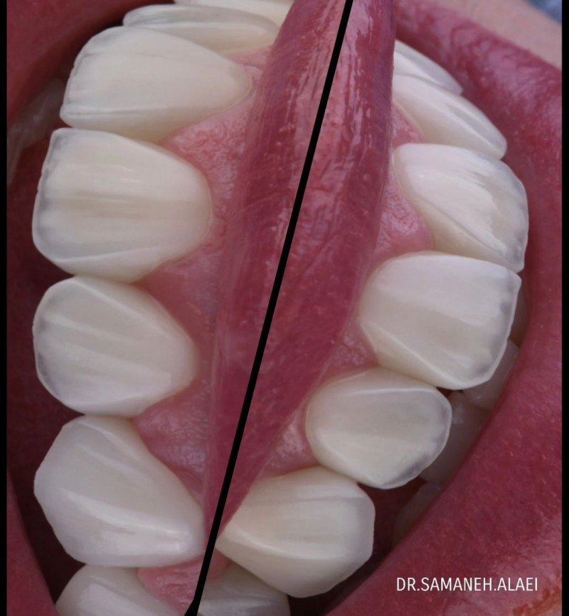 درمان لمینیت سرامیکی و فاصله بین دندانی در اصفهان