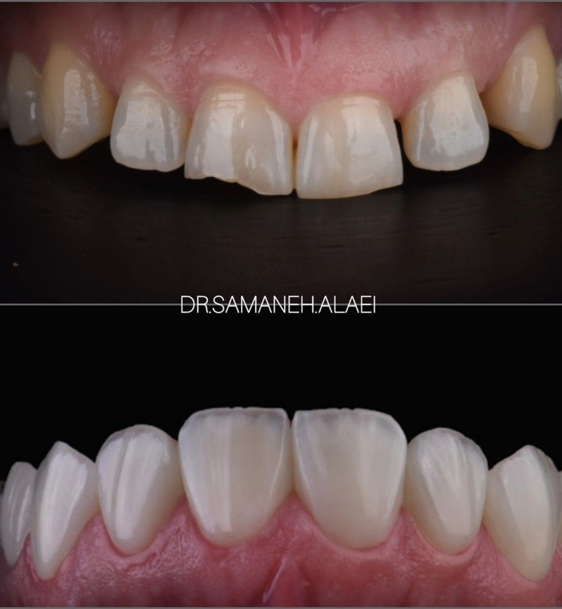 درمان لمینیت سرامیکی و فاصله بین دندانی در اصفهان