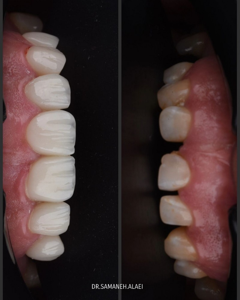 ونیر کامپوزیت در اصفهان