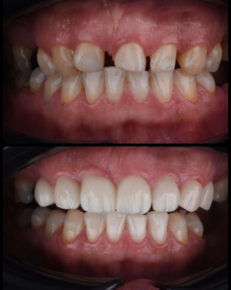 ونیر کامپوزیت در اصفهان