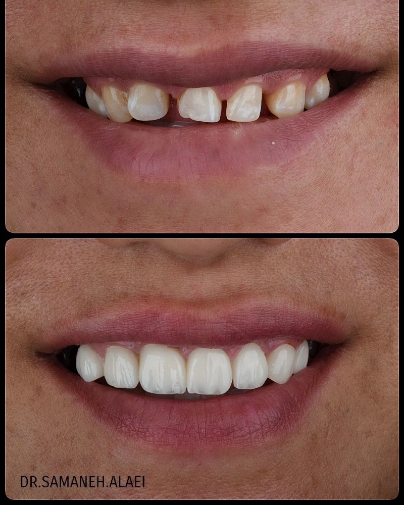 ونیر کامپوزیت در اصفهان