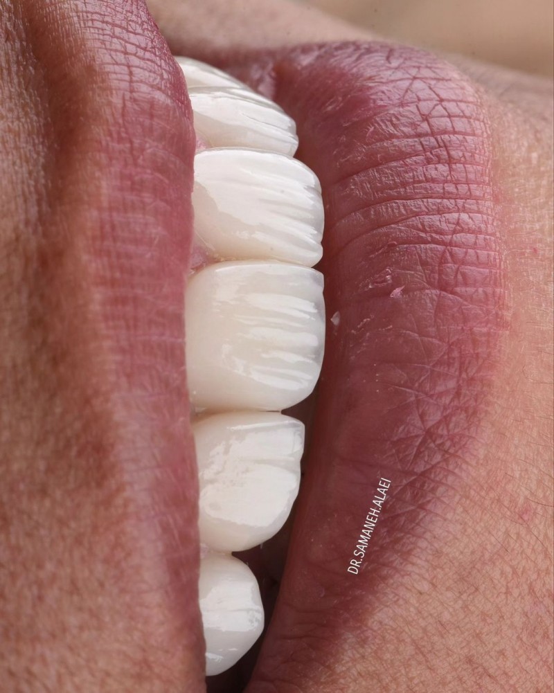 ونیر کامپوزیت در اصفهان