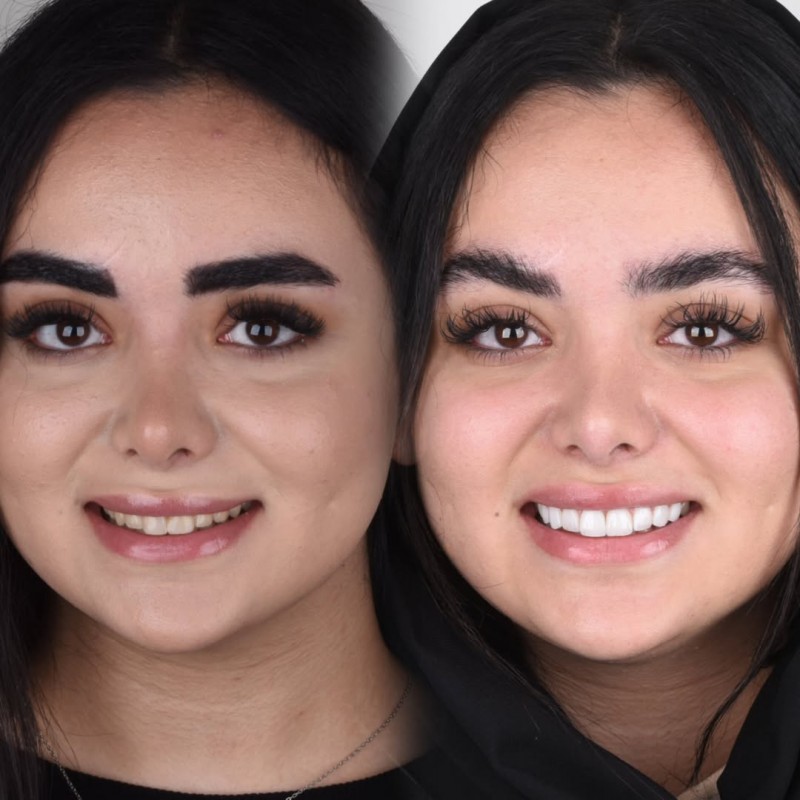 ونیر کامپوزیت در اصفهان در مرکز دندانپزشکی زیبایی دکتر سمانه علایی