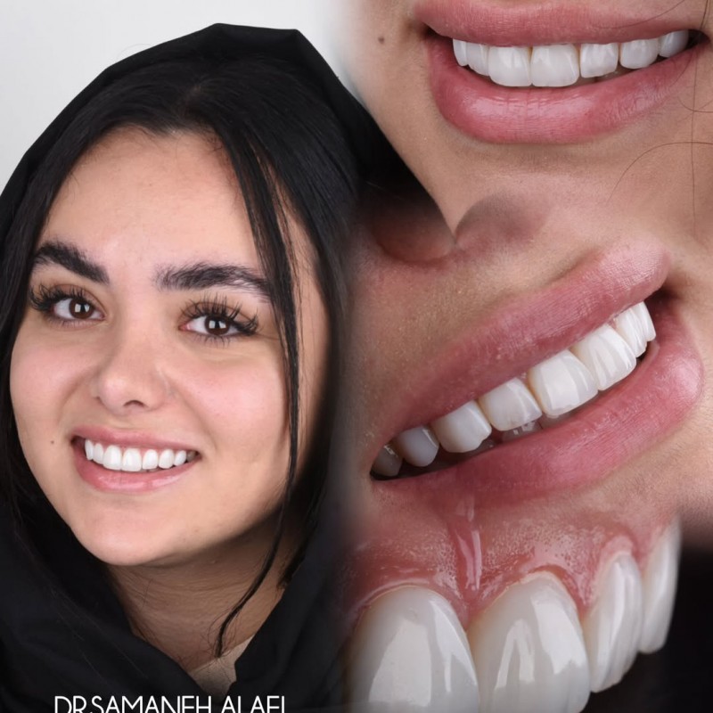 ونیر کامپوزیت در اصفهان در مرکز دندانپزشکی زیبایی دکتر سمانه علایی