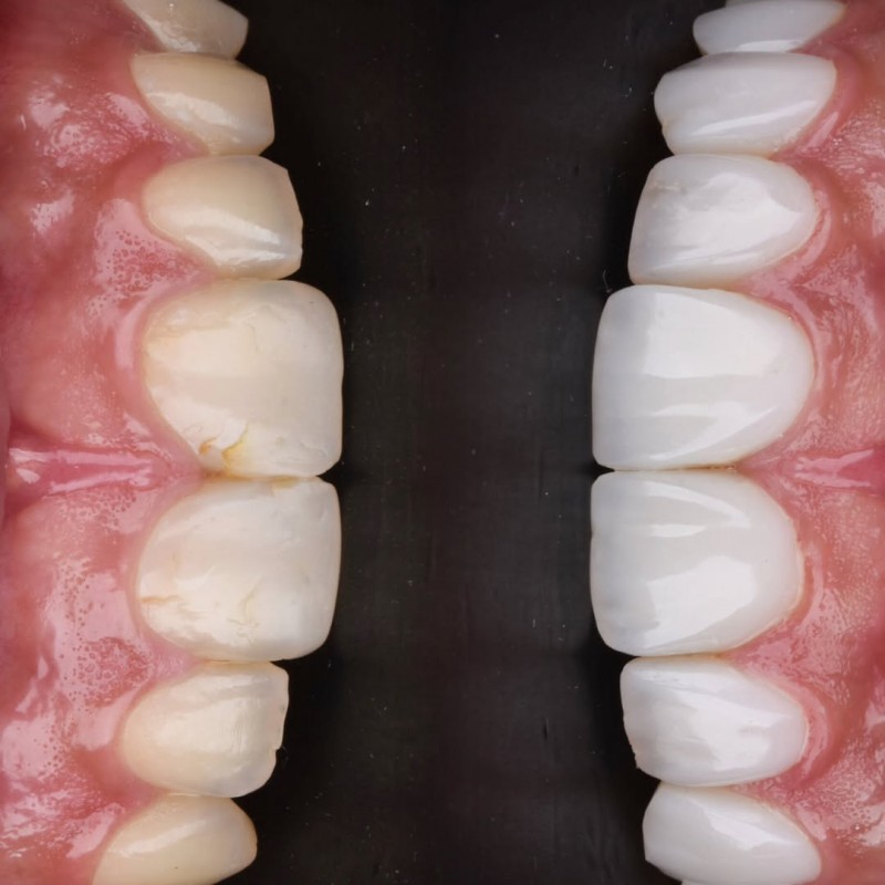 ونیر کامپوزیت در اصفهان در مرکز دندانپزشکی زیبایی دکتر سمانه علایی