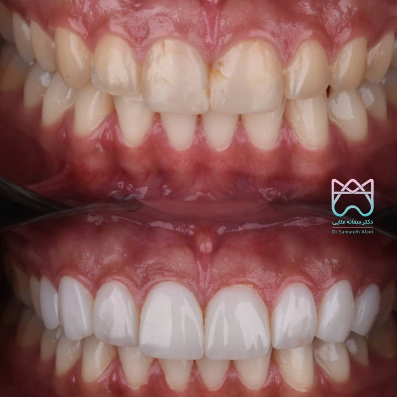 ونیر کامپوزیت در اصفهان در مرکز دندانپزشکی زیبایی دکتر سمانه علایی