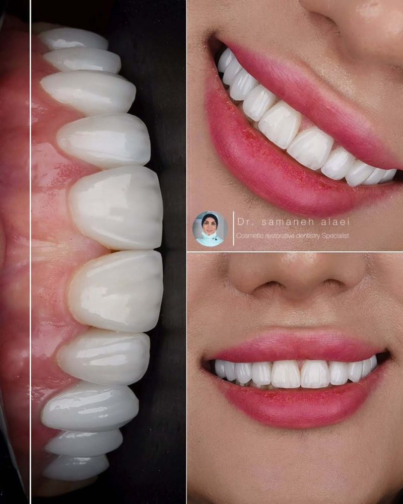 لمینیت سرامیکی دندان در اصفهان دکتر سمانه علایی متخصص دندانپزشکی ترمیمی و زیبایی