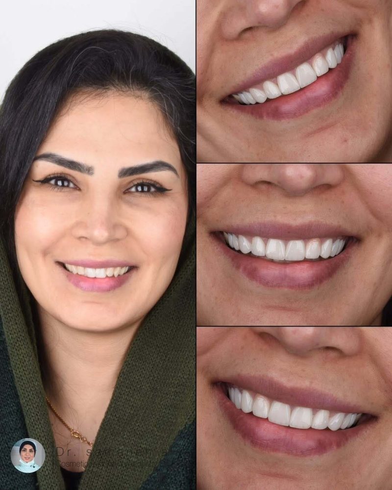لمینیت سرامیکی دندان در اصفهان دکتر سمانه علایی متخصص دندانپزشکی ترمیمی و زیبایی
